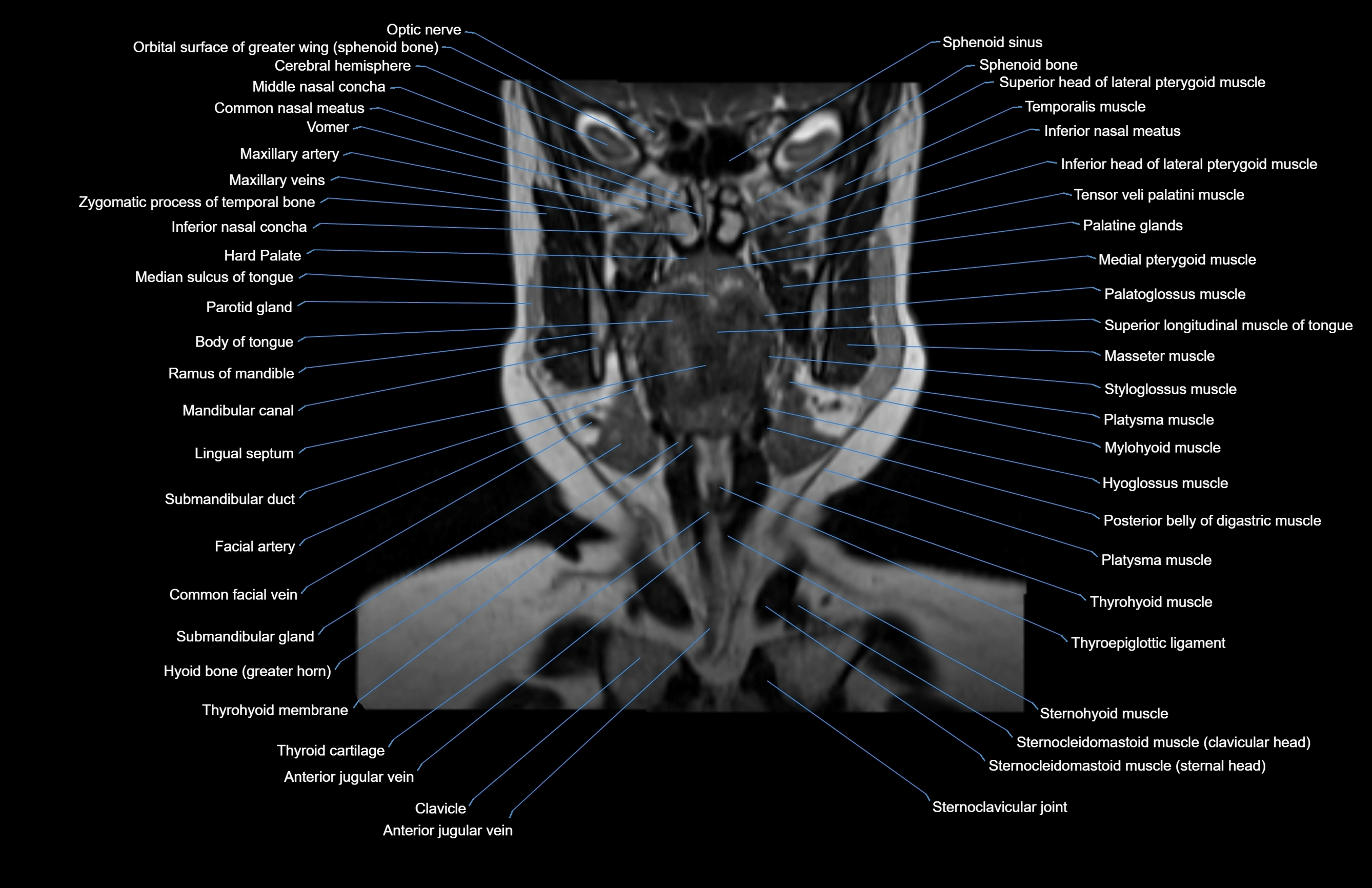 Neck coronal cross sectional MRI anatomy 3T MRI  image-img-00001-00050.webp
